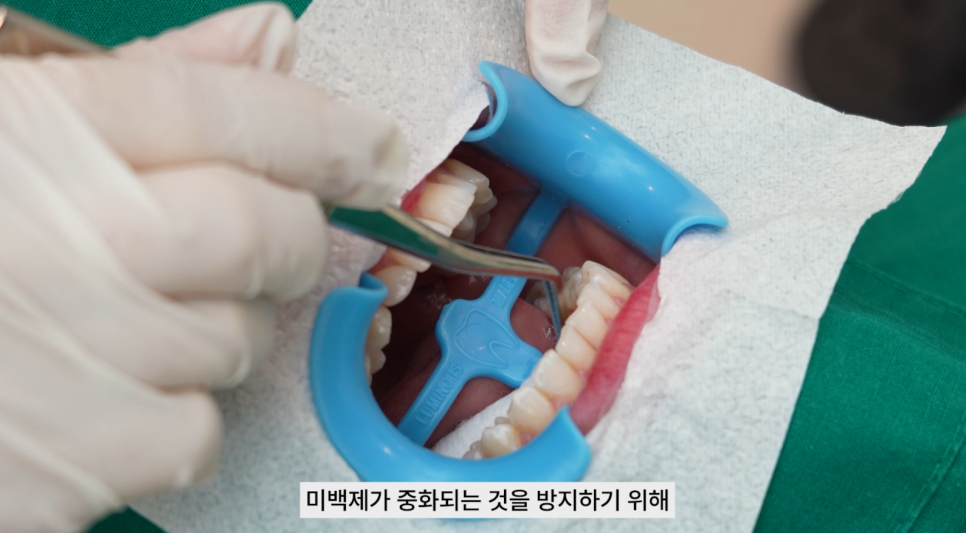 강남치과 원데이치아미백 누런치아 탈출 관련 이미지 6