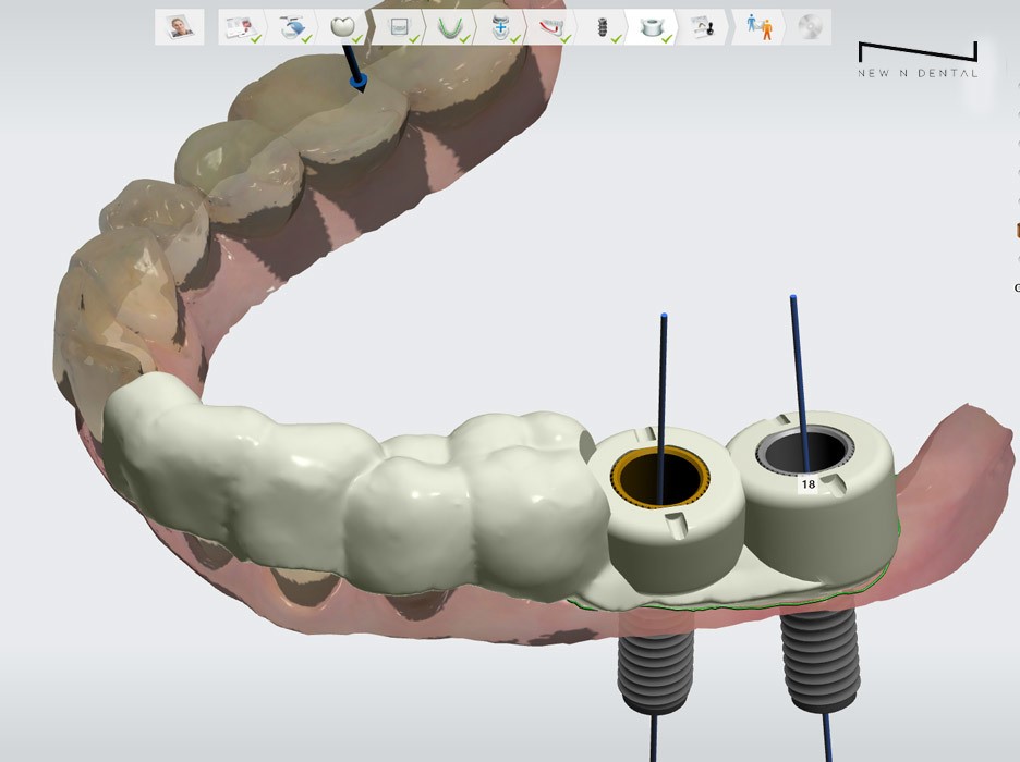 서초동임플란트치과 자연 치아가 탈락했다면 관련 이미지 4