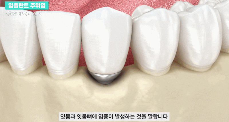 Gangnam Peri-Implantitis: Causes, Symptoms, and Prevention image 2