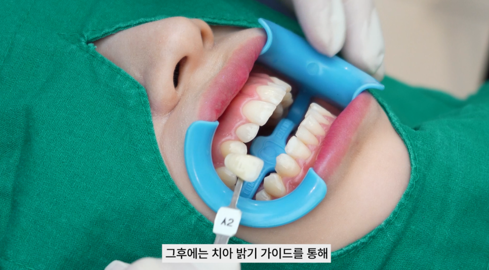 강남치과 원데이치아미백 누런치아 탈출 관련 이미지 3