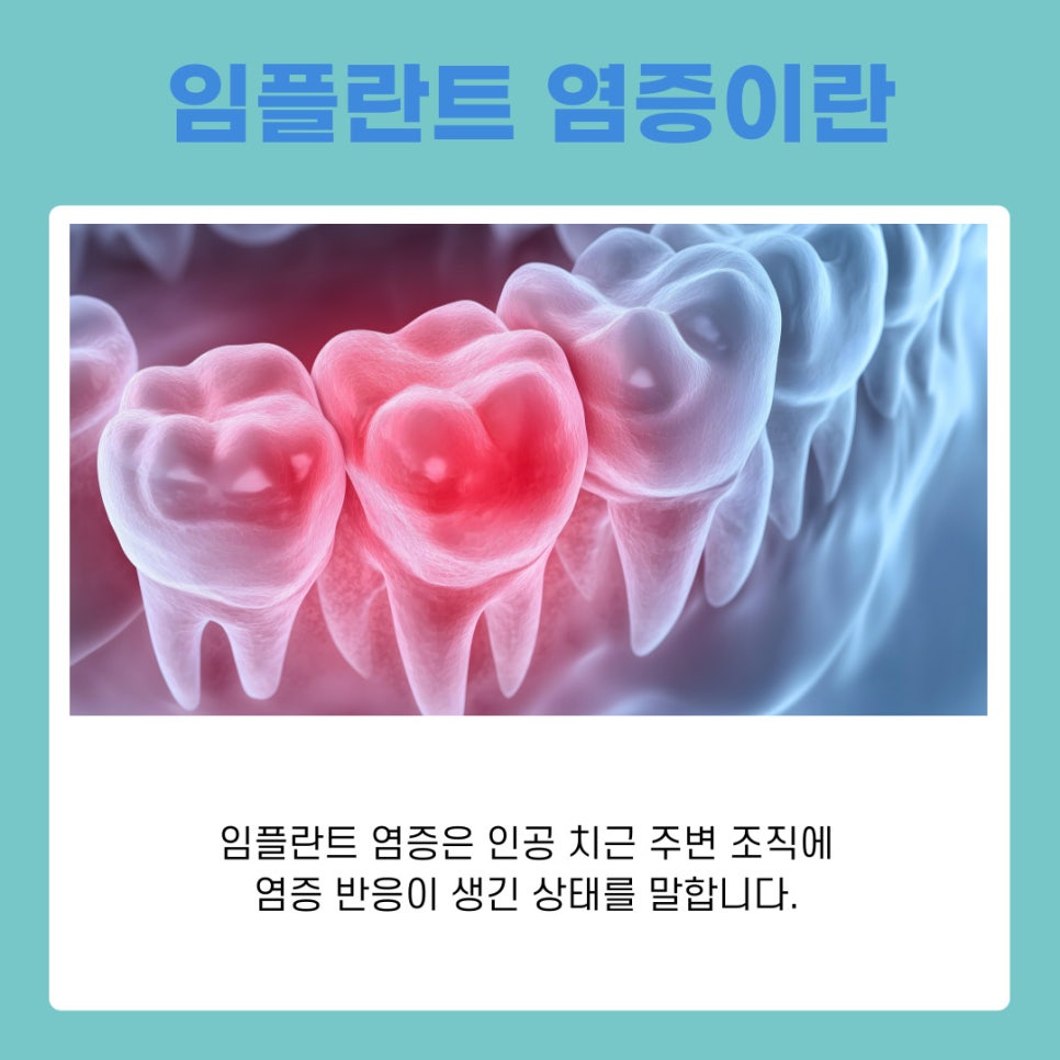역삼동 임플란트 염증 초기 원인부터 예방법까지 한 번에 보기 관련 이미지 3