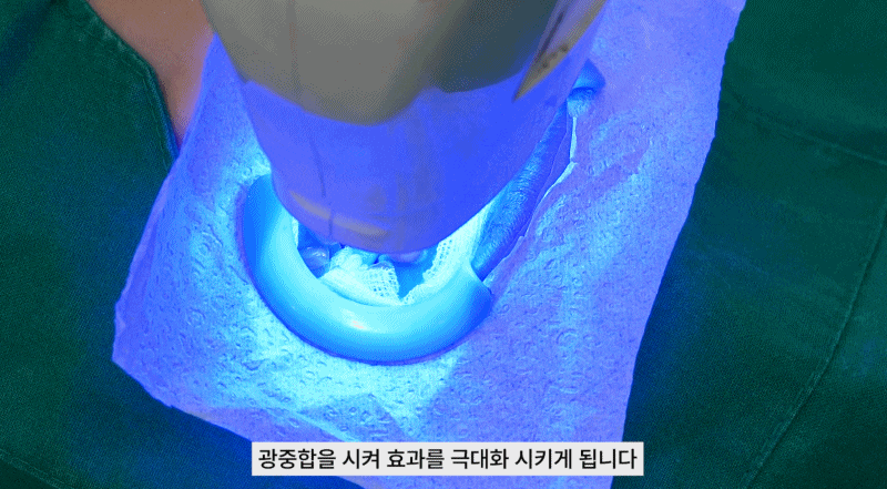 강남치과 원데이치아미백 누런치아 탈출 관련 이미지 10