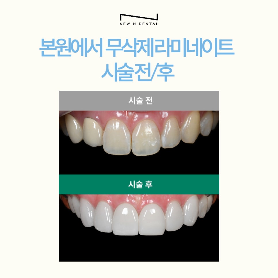 강남 무삭제라미네이트 잘하는 뉴엔치과 자연스러운 미소 관련 이미지 7