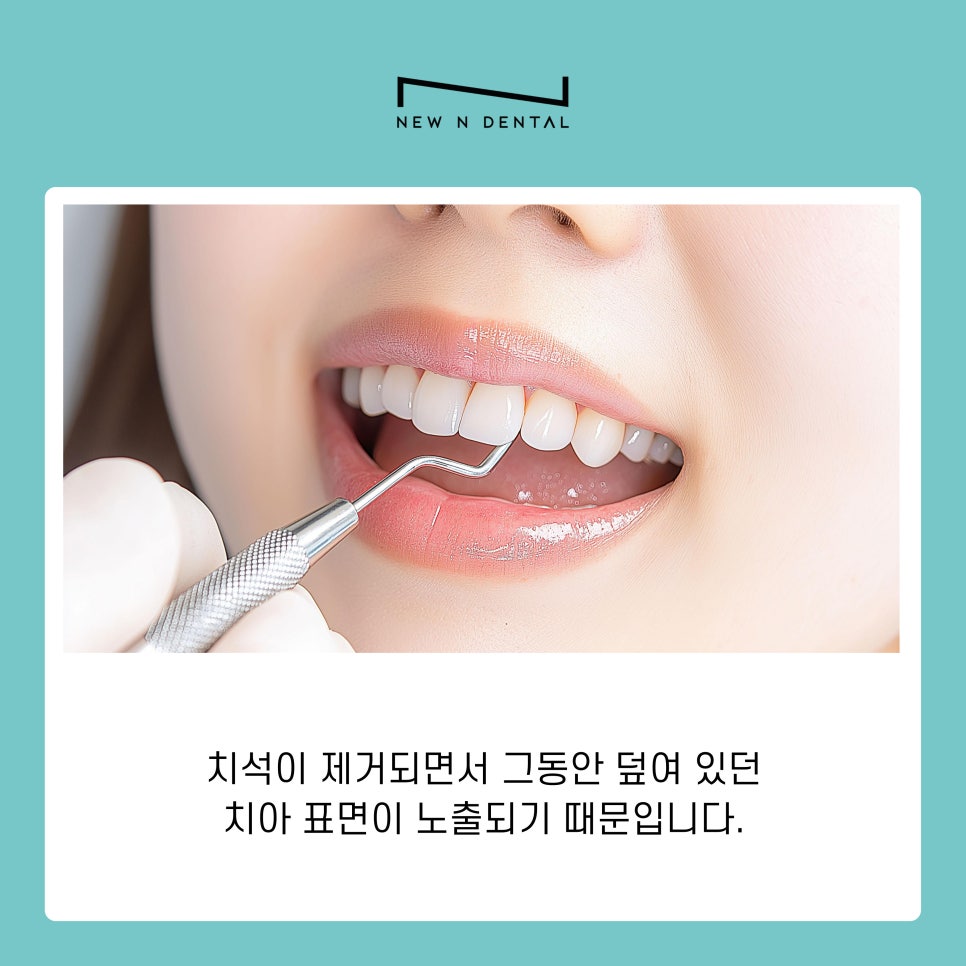 신사동 치과 스케일링후 관리 방법과 주의사항 관련 이미지 4