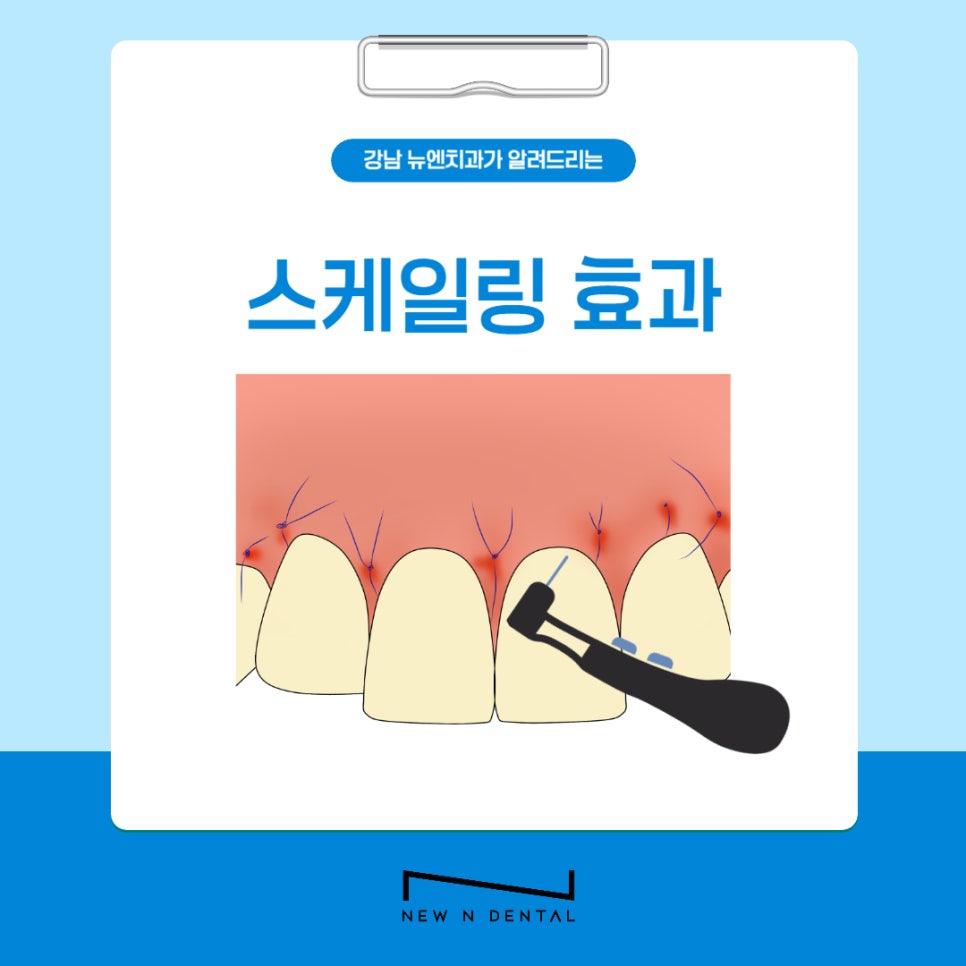 강남역 스케일링 잘하는 곳 뉴엔치과 치아건강 꿀팁 관련 이미지 6