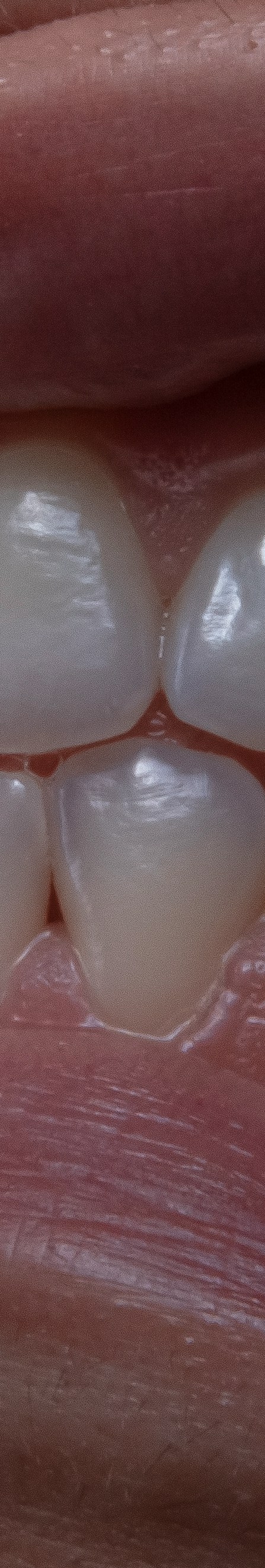 치아 미백 효과와 부작용 체크해야 할 사항 관련 이미지 23