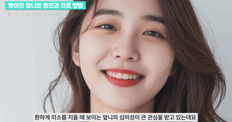 강남역치과 앞니 벌어짐 원인, 치료와 방법 관련 이미지 2