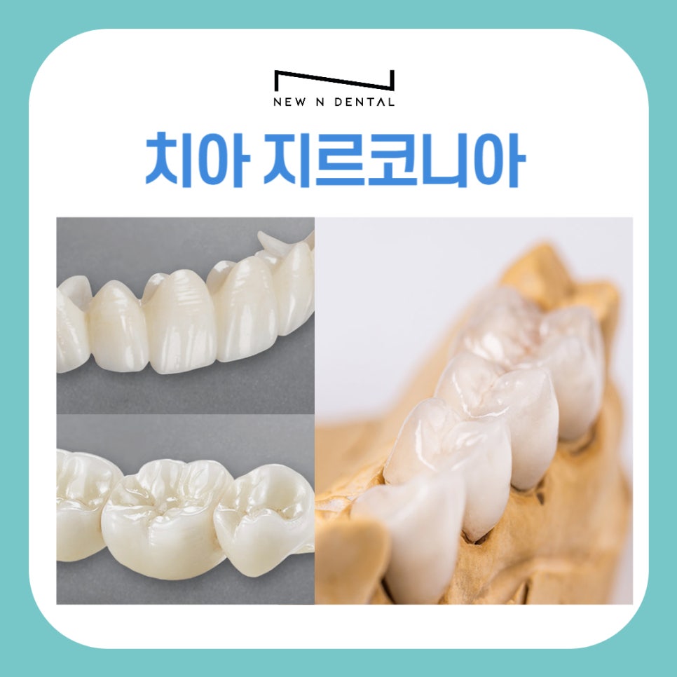 치아 지르코니아 크라운 중요한 요소 관련 이미지 2