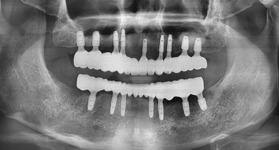 논현동임플란트잘하는곳 컴퓨터 분석으로 보다 면밀하게 관련 이미지 6
