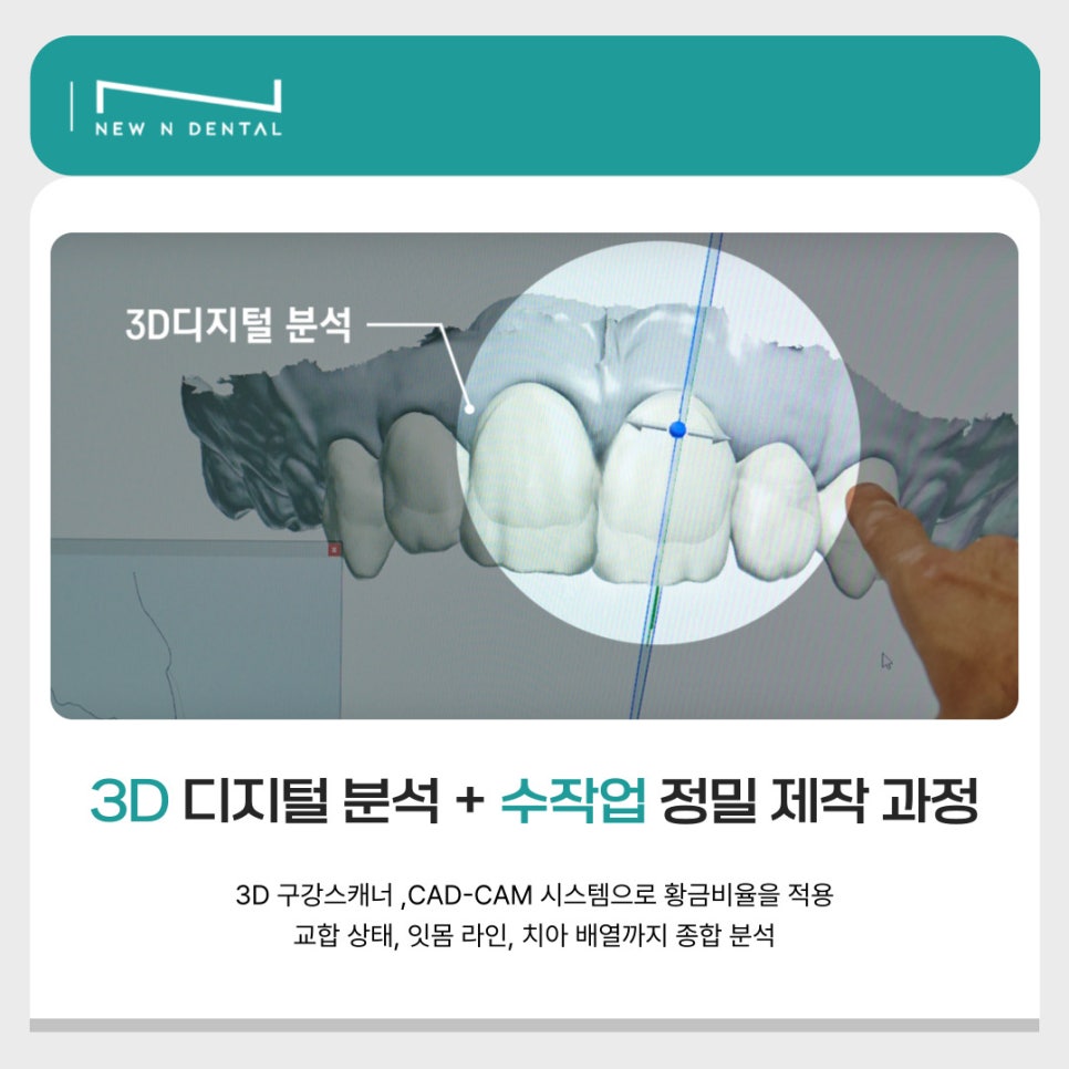 뉴엔치과만의 특별함, 퍼스널라미 관련 이미지 5