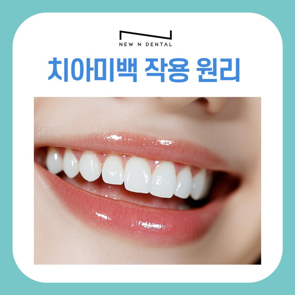 강남 논현동치과 치아미백 작용 원리와 유지 관리 방법 정리 관련 이미지 2