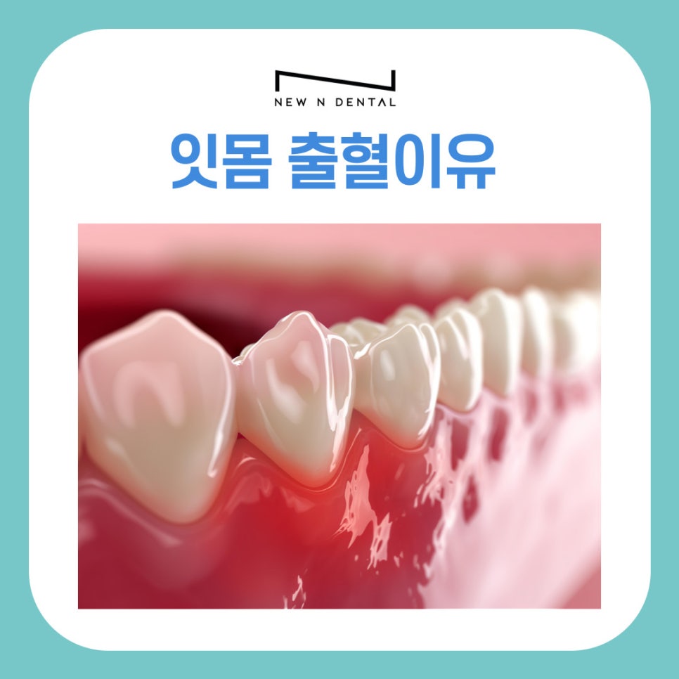 서초동치과 잇몸 출혈 방치하면 안되는 이유 관련 이미지 2