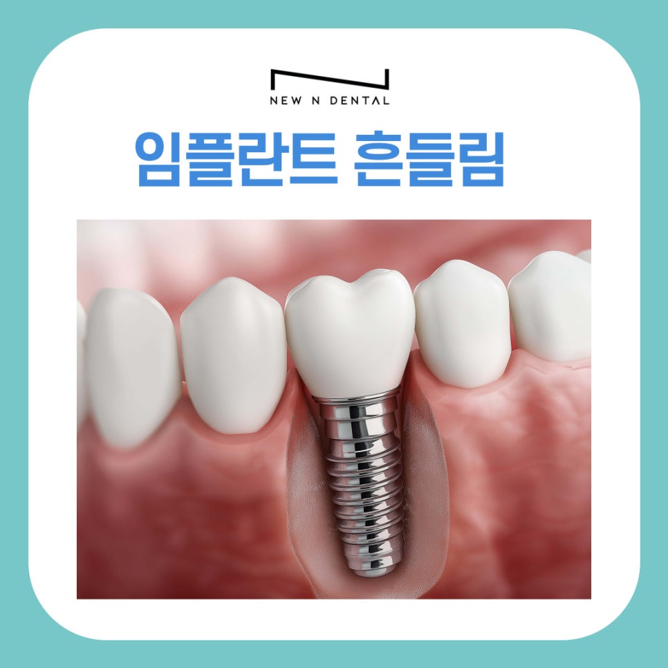 강남역임플란트치과 흔들림 발생 시 확인해야 할 원인과 대응법 관련 이미지 2