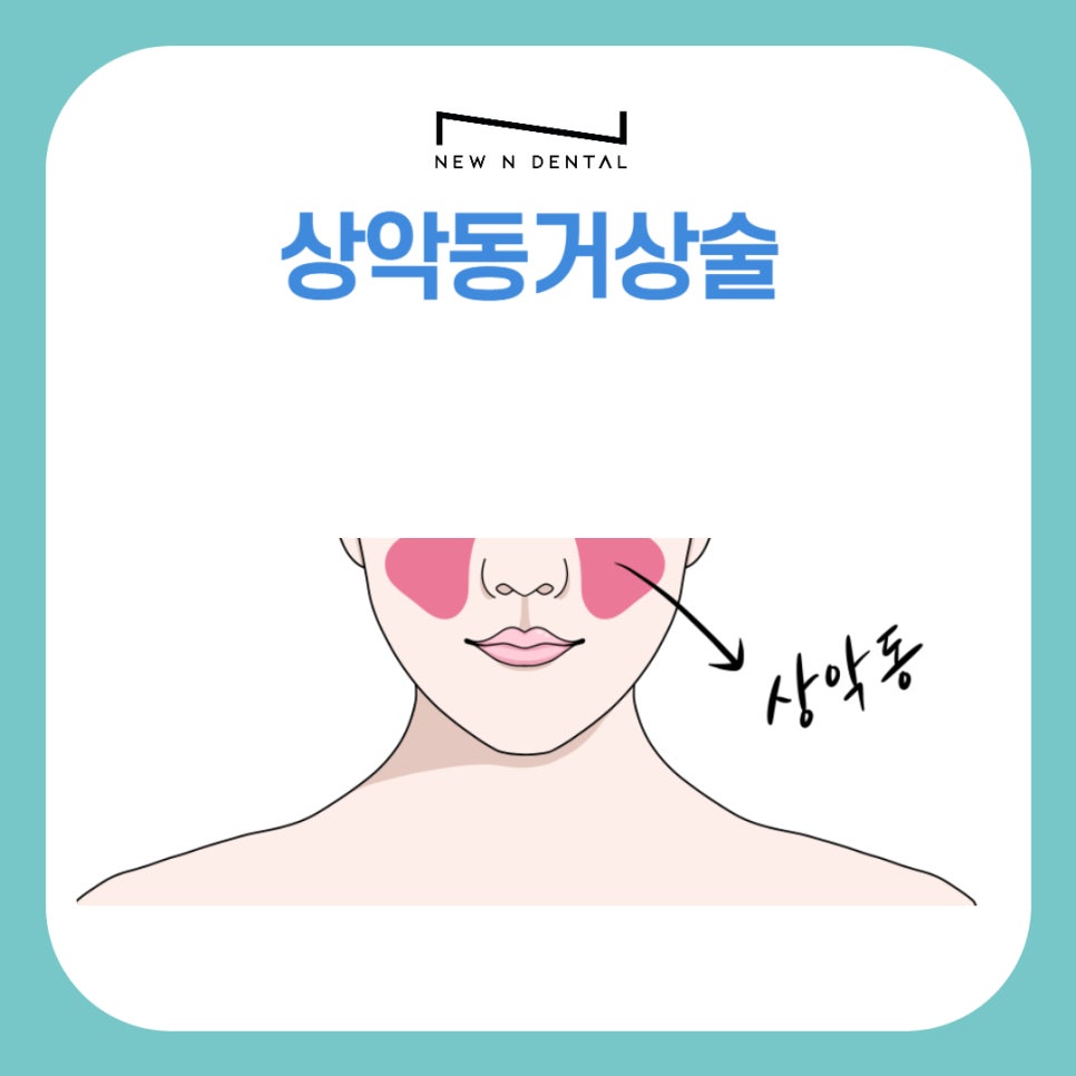 논현역치과 상악동거상술 어떤 치료일까 관련 이미지 2