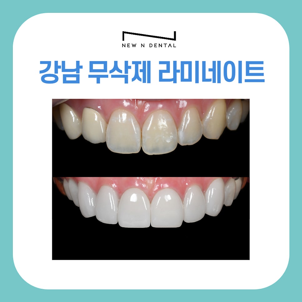 강남 무삭제라미네이트 잘하는 뉴엔치과 자연스러운 미소 관련 이미지 1
