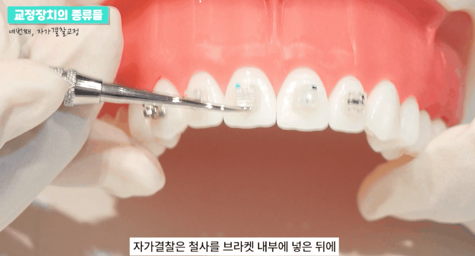 강남 클리피씨 교정기간 짧은 찐후기 관련 이미지 6