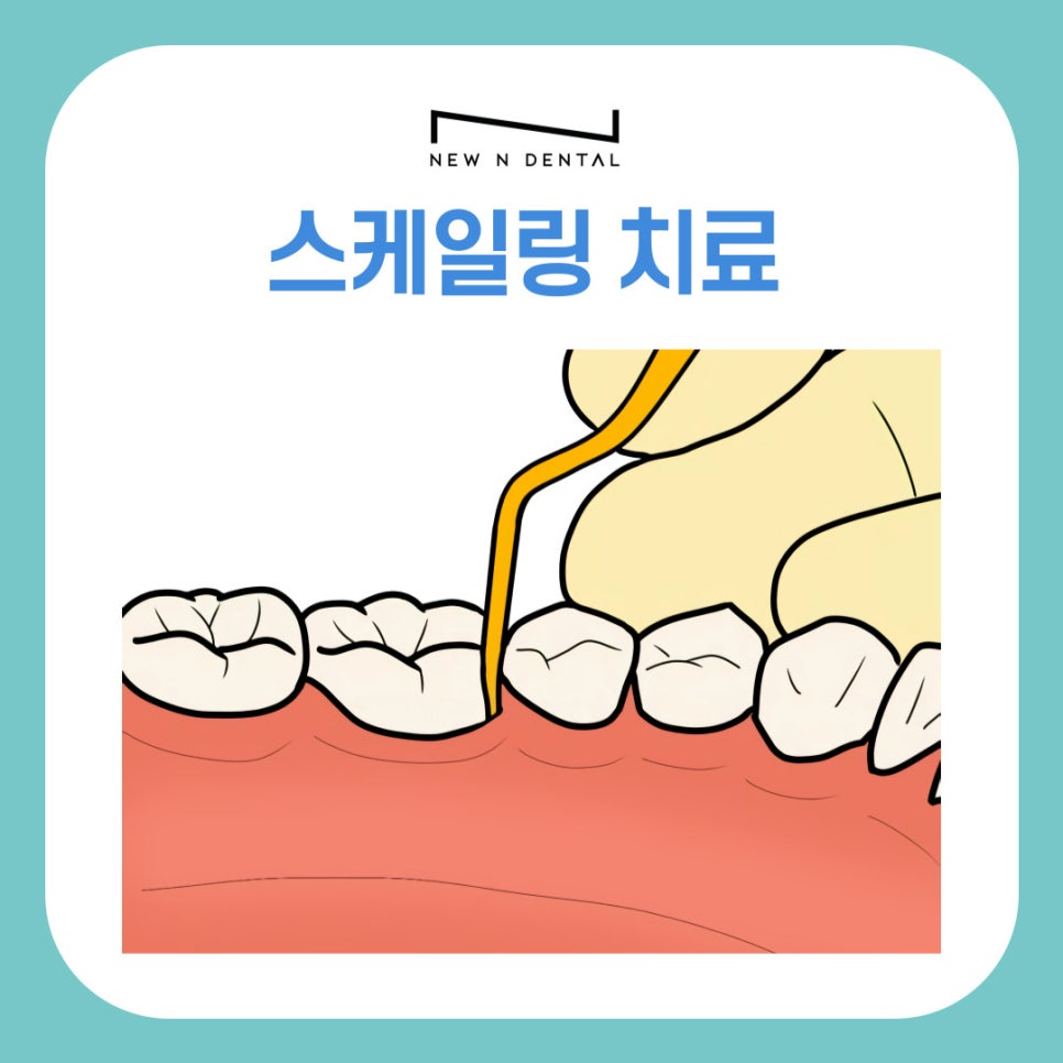 서초동치과 잇몸 출혈 방치하면 안되는 이유 관련 이미지 8