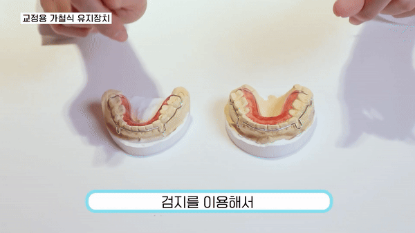 강남교정치과추천 완벽한 치열을 향한 여정 관련 이미지 3