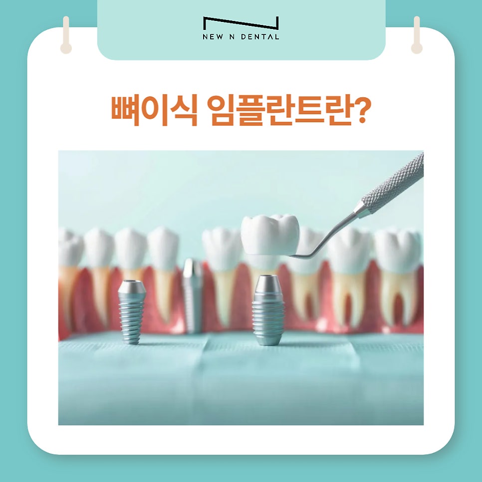 뼈이식임플란트, 잇몸뼈 부족 고민 완벽 해결 관련 이미지 2