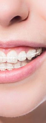 디지털 장비를 이용한 맞춤 치아 교정 관련 이미지 11