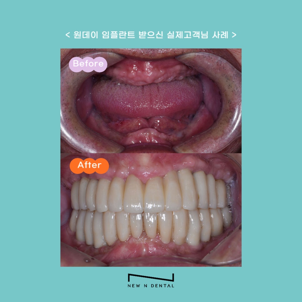 원데이 임플란트 빠르게 치료하려면 관련 이미지 9