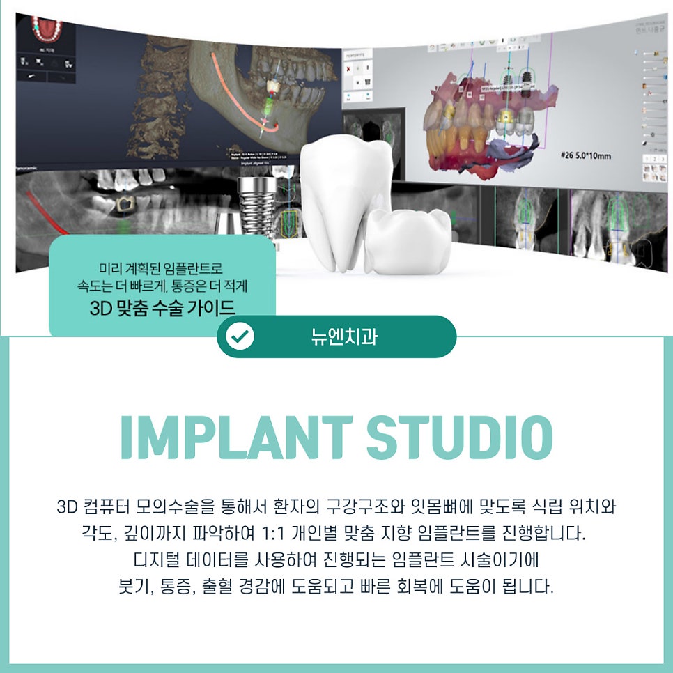 임플란트수술비용과 치료 과정에 대한 정보 관련 이미지 8