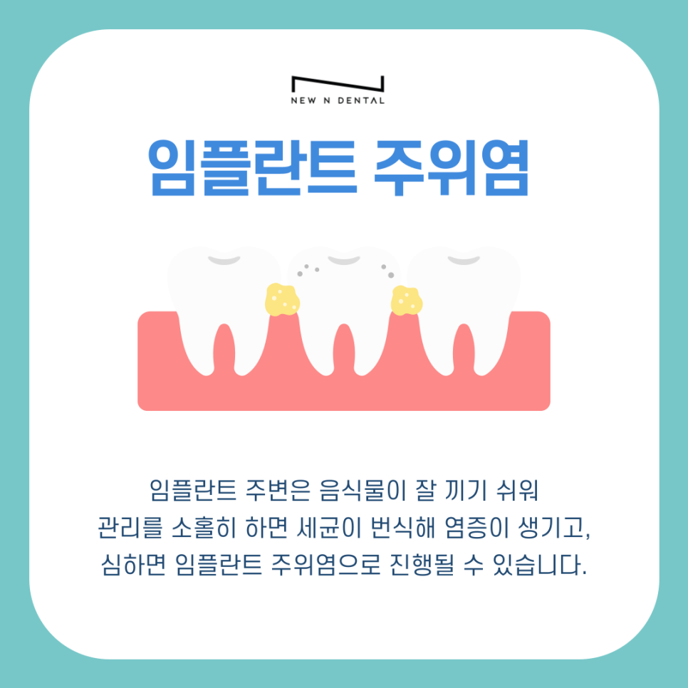강남역치과 임플란트 수명 얼마나 사용할 수 있을까? 관련 이미지 5