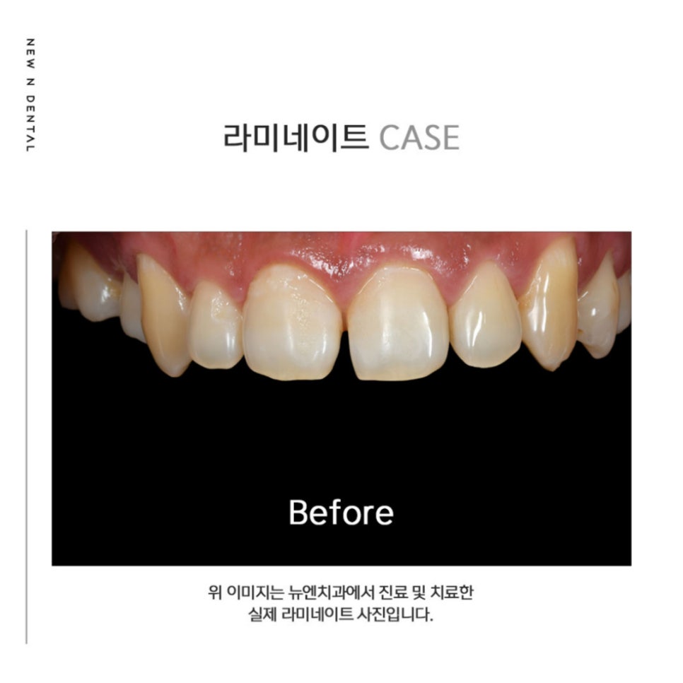 자연치아를 최대한 보호하는 최소삭제라미네이트 관련 이미지 11