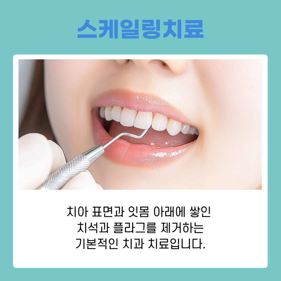 치아변색원인과 스케일링치료로 개선하는 방법 관련 이미지 5