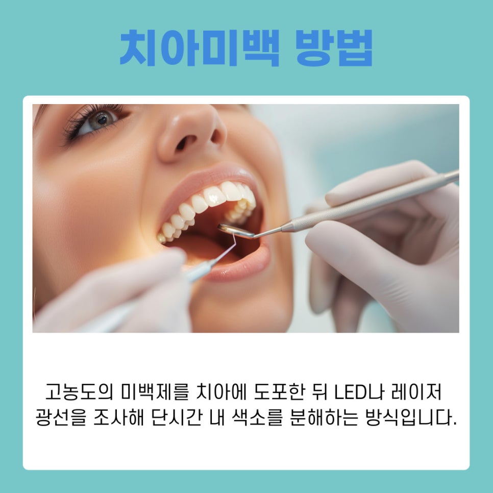 강남역치과 치아미백 원리부터 관리 방법 까지 관련 이미지 5