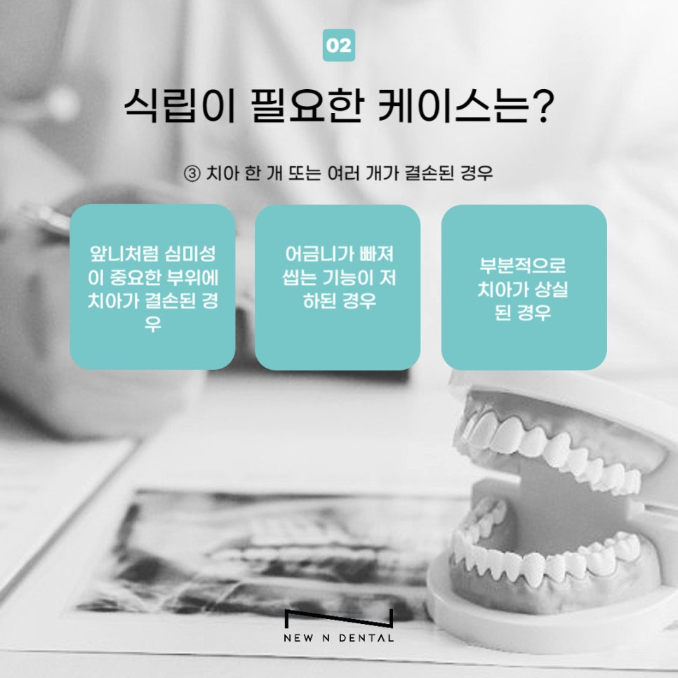 강남임플란트추천 식립 고민중이라면 관련 이미지 4