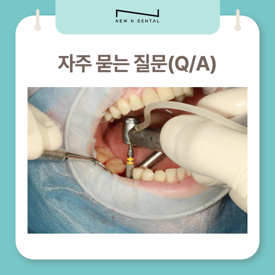 뼈이식임플란트, 잇몸뼈 부족 고민 완벽 해결 관련 이미지 8