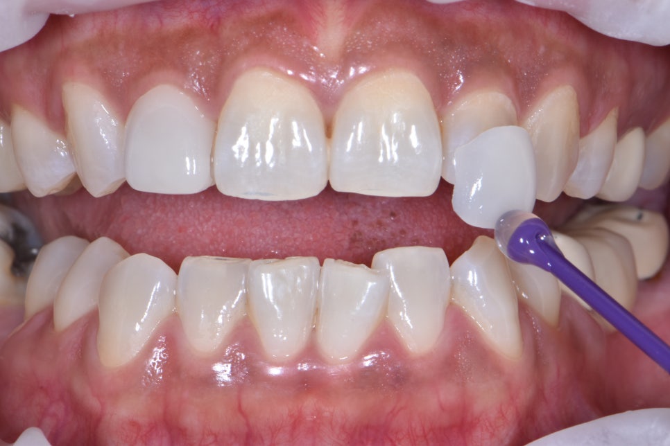 서초동라미네이트 치아를 아름답게 관련 이미지 4