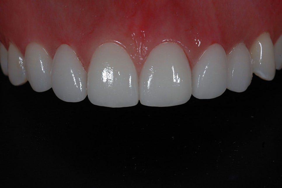 서초동라미네이트 치아를 아름답게 관련 이미지 6