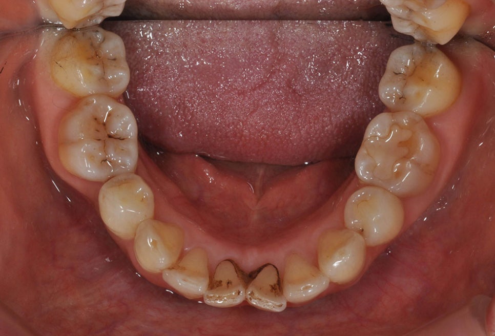 논현동치아교정치과 고른 치아를 위해서 관련 이미지 4