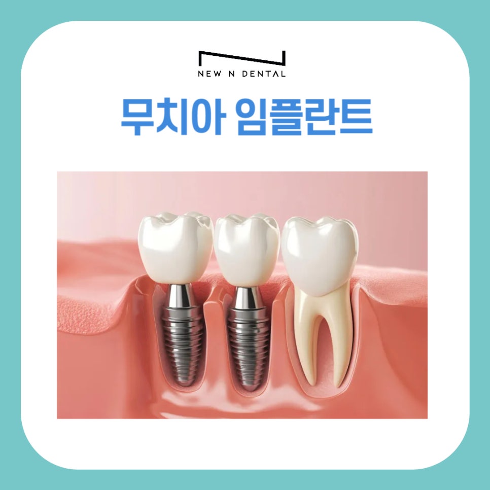 신논현치과 무치아 임플란트, 틀니보다 확실한 선택 관련 이미지 1
