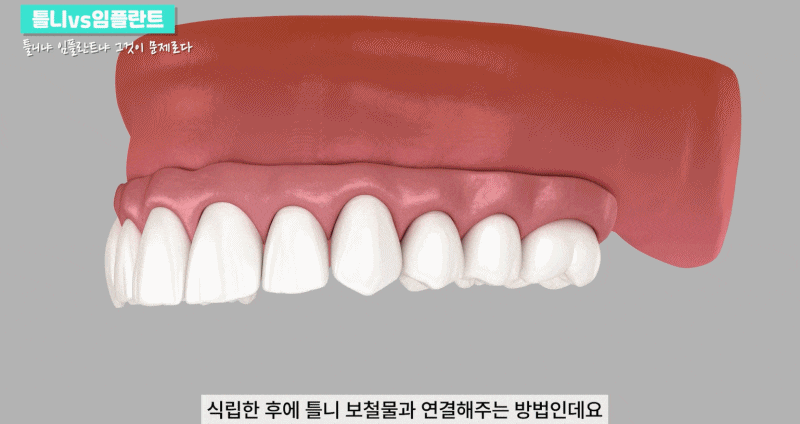Implant Dentures for a Healthy Fit Without Wobbling image 4