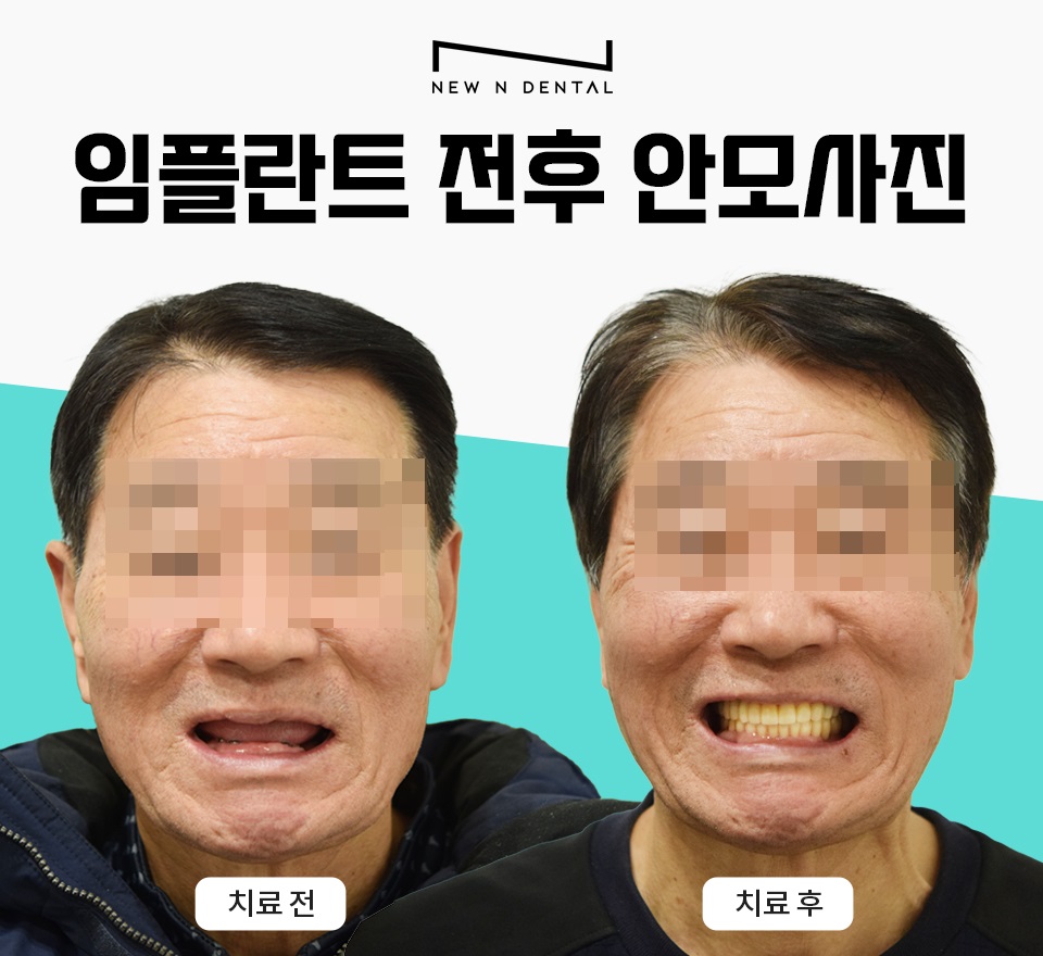 서초동임플란트치과 자연 치아가 탈락했다면 관련 이미지 8