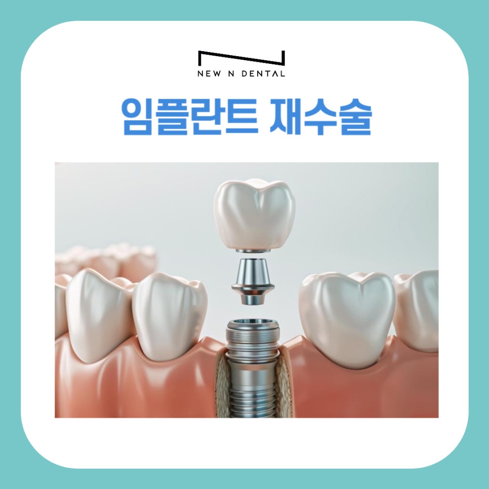 임플란트 재수술, 꼭 필요한 경우만 진행해야 합니다 관련 이미지 2