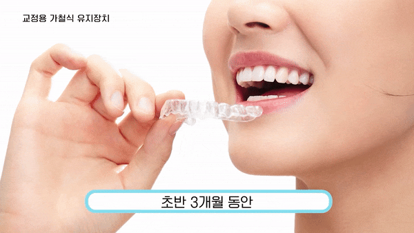 개방교합교정 생소하고 어렵다면 관련 이미지 5