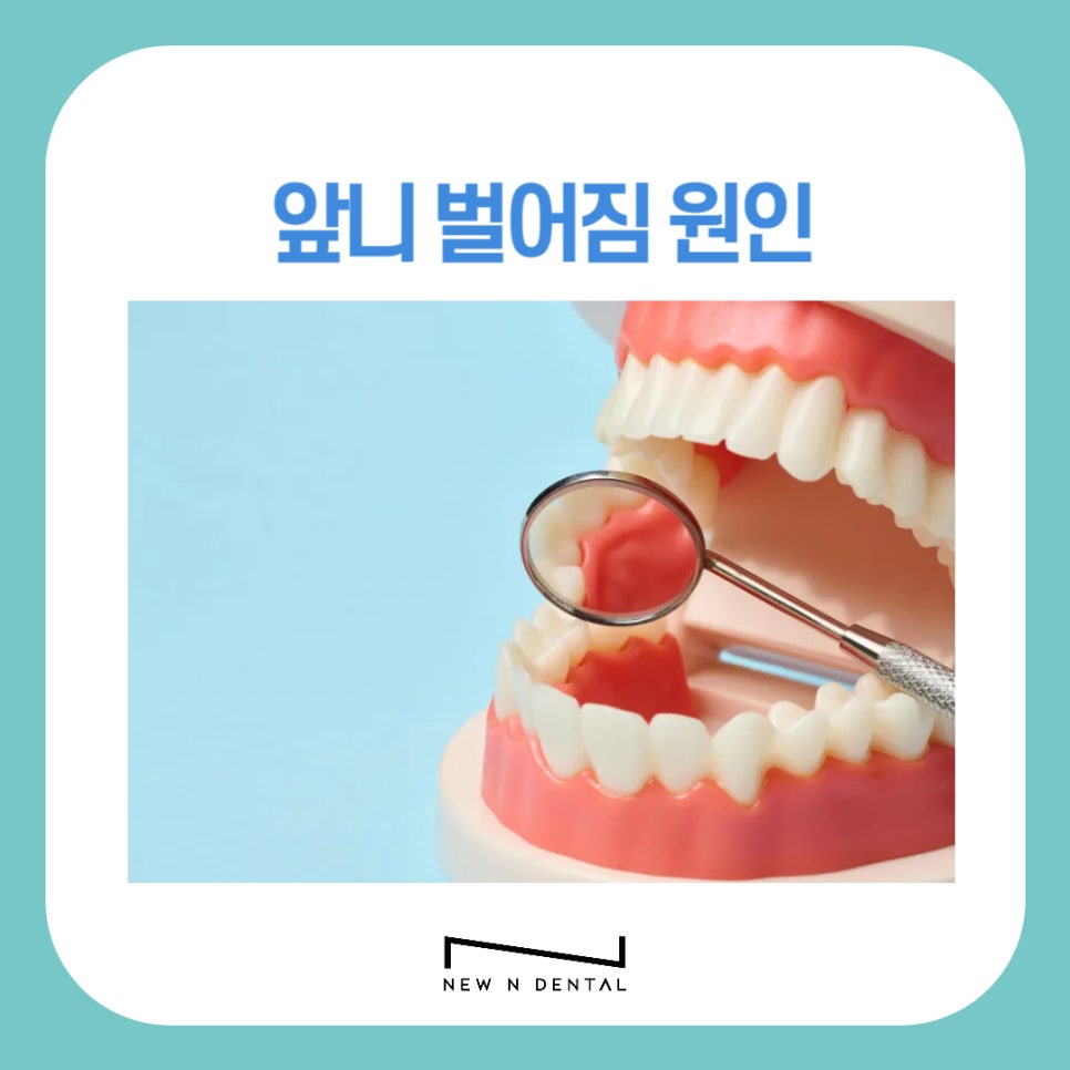 강남역치과 앞니 벌어짐 원인, 치료와 방법 관련 이미지 1