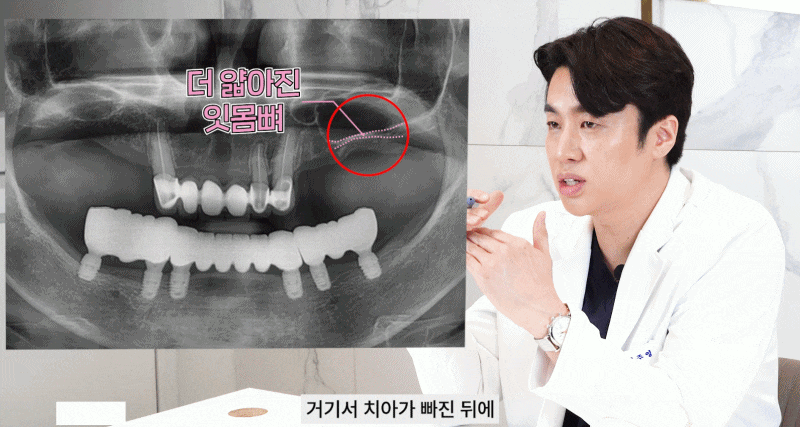 논현역치과 상악동거상술 어떤 치료일까 관련 이미지 8