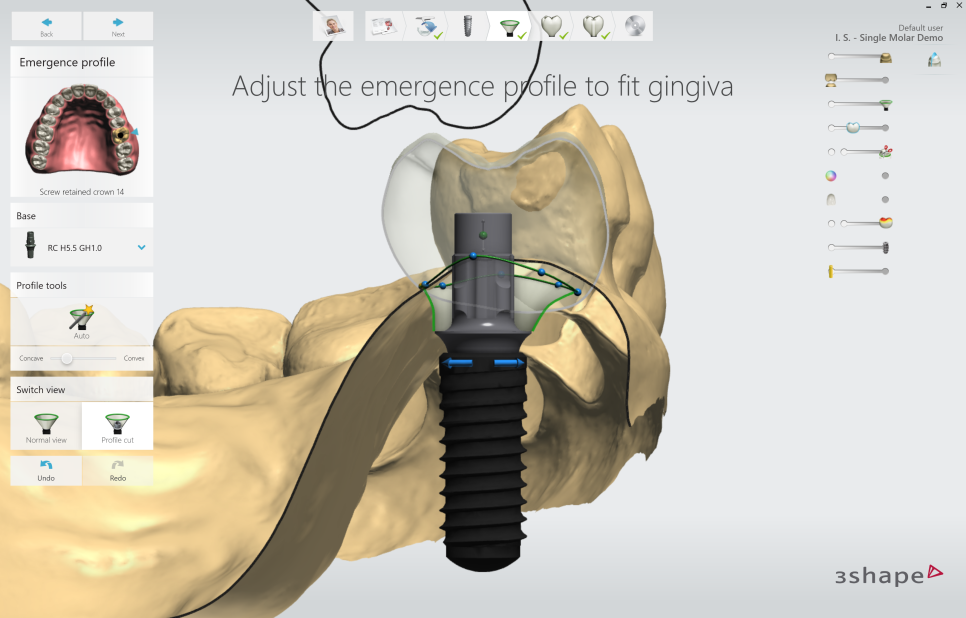 논현동임플란트잘하는곳 컴퓨터 분석으로 보다 면밀하게 관련 이미지 4