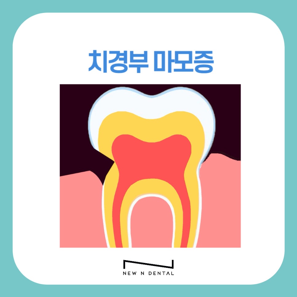 신논현치과 치경부마모증 원인과 치료 관련 이미지 1