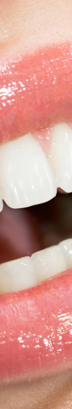 강남 무삭제라미네이트 치아깎지않는 개선방법 관련 이미지 13