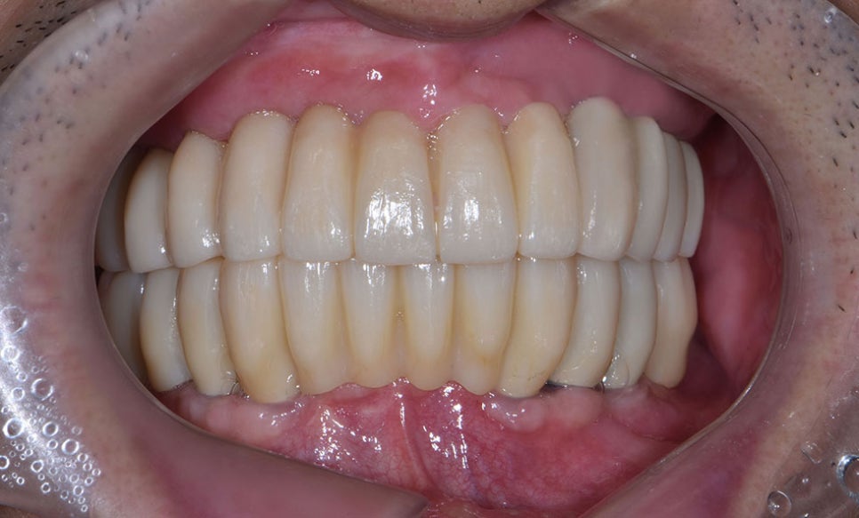 역삼동임플란트추천 치아를 건강하게 관련 이미지 5