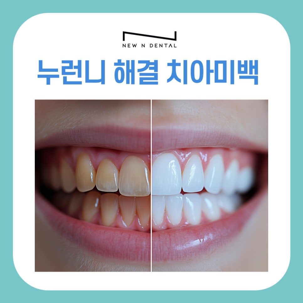 강남역 치아미백 누런니 고민해결 밝은 미소 되찾는 법 관련 이미지 2