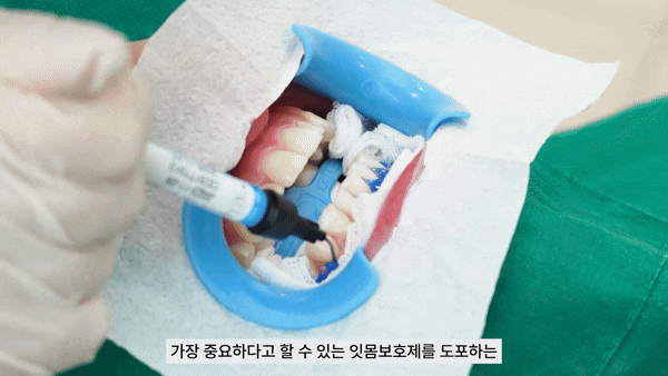 강남치아미백 밝고 투명한 자신감 관련 이미지 7