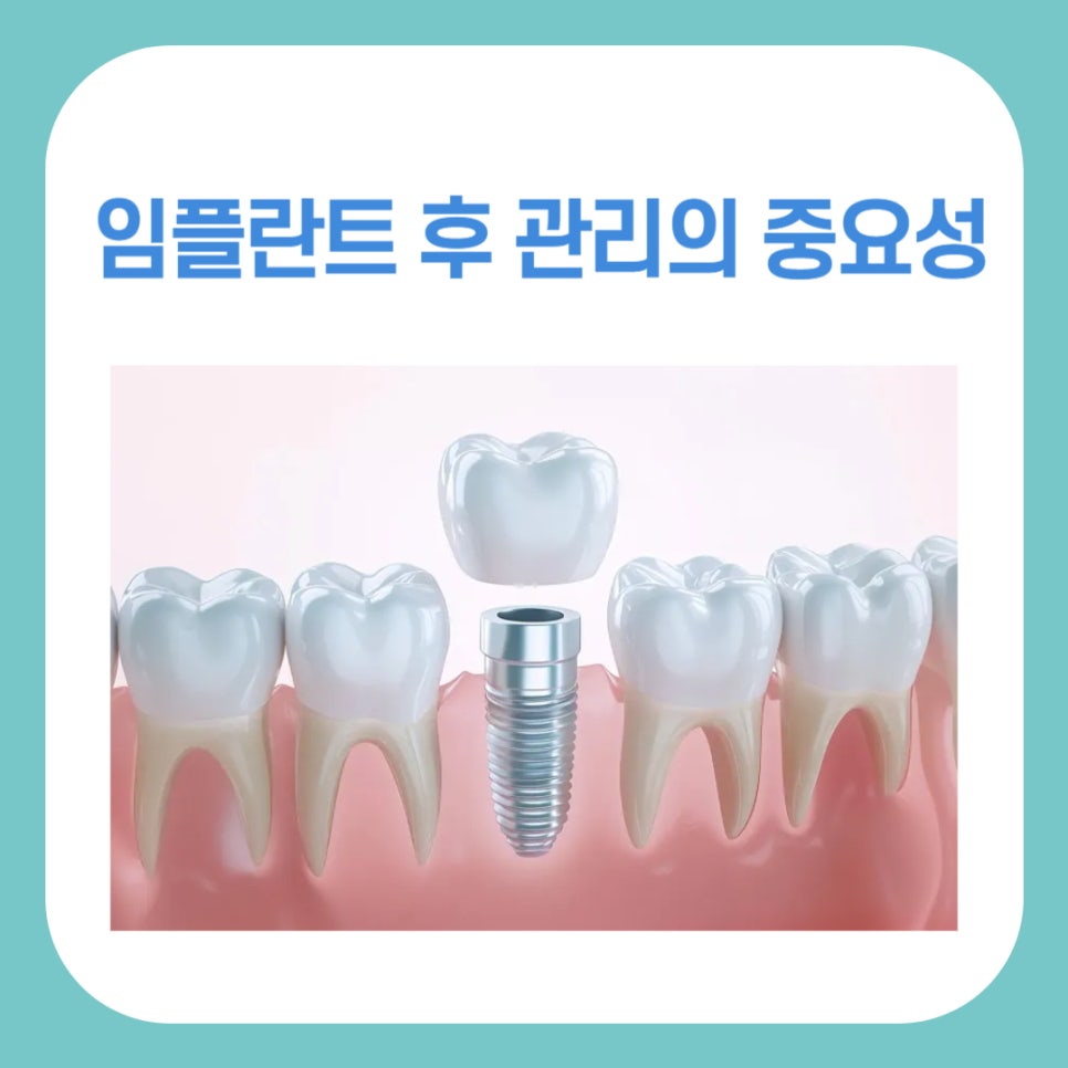 임플란트 후 관리의 중요성 관련 이미지 1