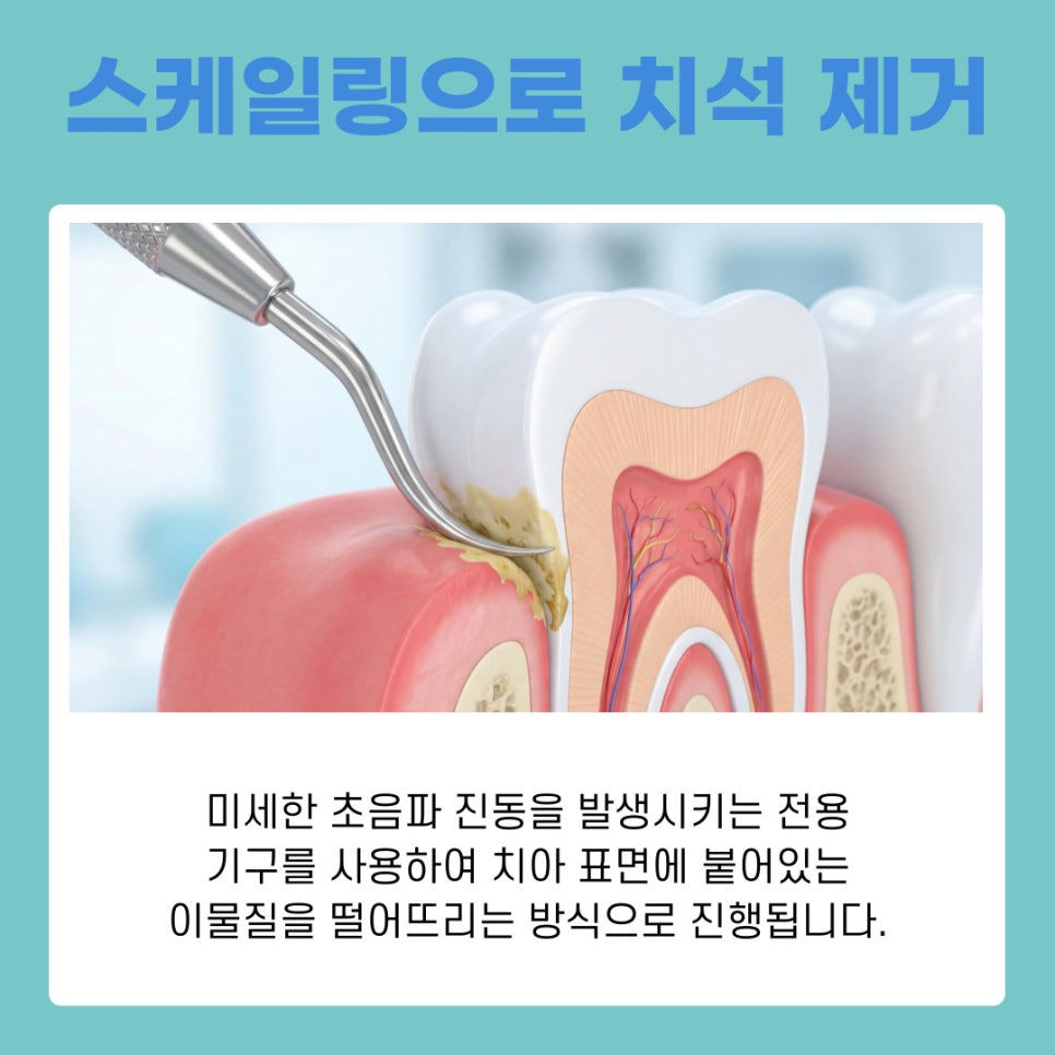 Gangnam Scaling Frequency and Essential Care for Preventing Gum Disease image 7